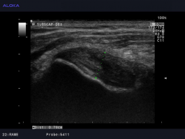 Ultrazvok rame - tendinoza mišice subscapularis ob narastišču na mali tuberkel